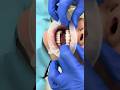 How Should I Operate An Optragate For Patient?!