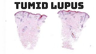 Tumid lupus erythematosus (red firm skin plaques nodules on trunk) pathology dermpath screenshot 5