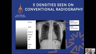 BASIC CHEST X RAY INTERPRETATION โดย พญ.น้ำฝน สินชัย