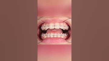 Khắc phục tình trạng chen chúc khấp khểnh bằng phương pháp niềng| Lạc Việt Intech Niềng Răng #shorts