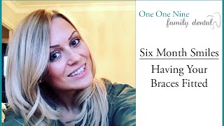 Having Your Six Month Smiles Braces Fitted