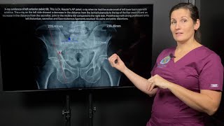 Sciatica and leg length discrepancy connection to Sacroiliac joint instability