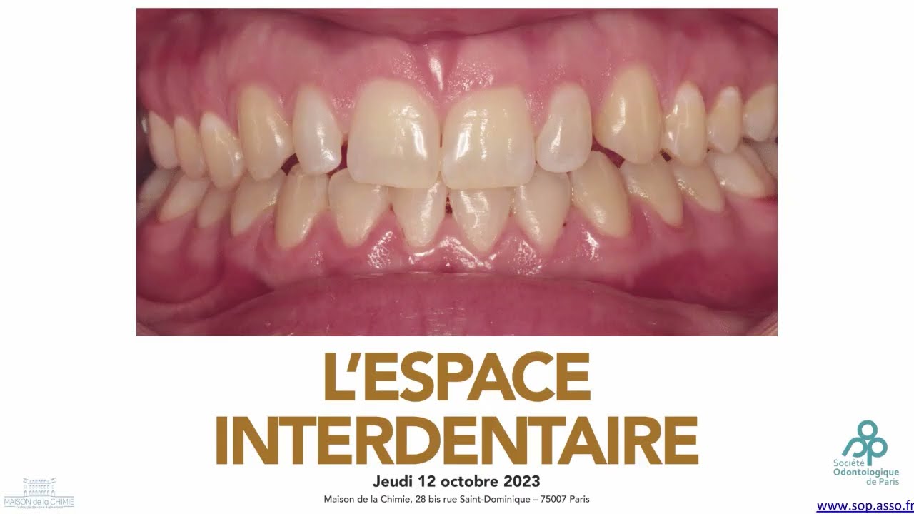 « Les aspects fondamentaux » sur l'espace interdentaire ou interproximal