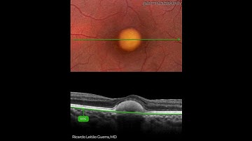 Vitelliform Dystrophy - Multimodal Imaging Analysis