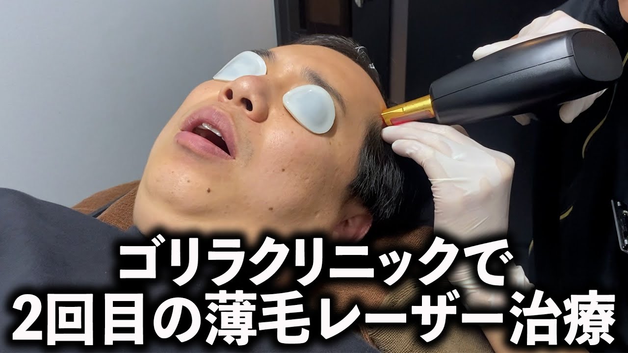 ゴリラクリニックで2回目の薄毛レーザー治療