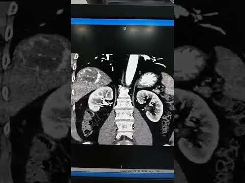 Hydatid.cyst with calcified wall /ctscan findings/ Radiology