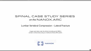 Clinical Case Study | Vertebral Compression Fracture (Lateral View) | Nanox Vision