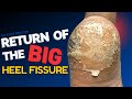 Return of the Big Heel Fissure