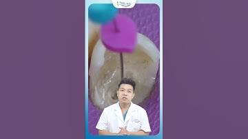 Cách Xử Lý Răng Sâu Vào Tủy Để Không Cần Nhổ Răng | Nha Khoa Minh Châu