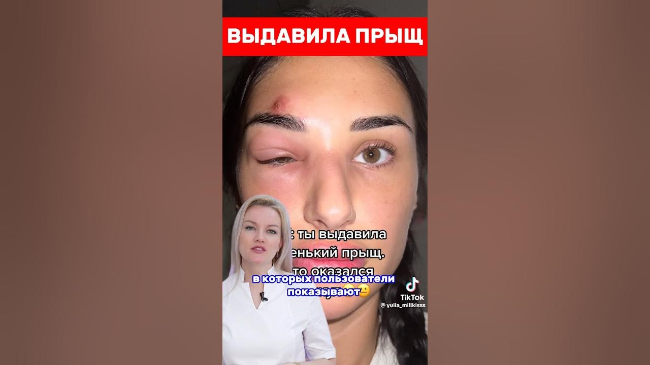 Почему НЕЛЬЗЯ выдавливать ПРЫЩИ? Страшная правда - YouTube
