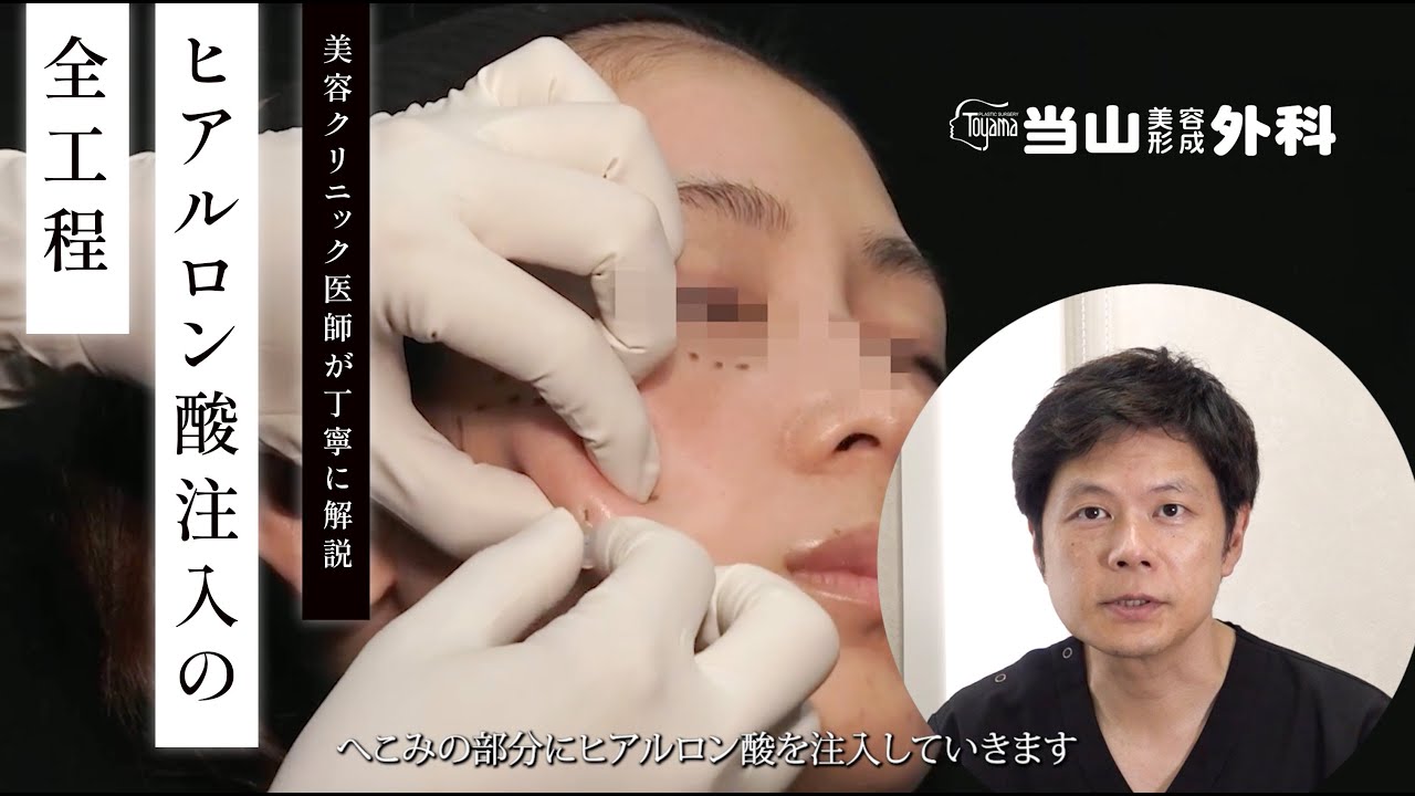 治療風景】美容クリニック医師が丁寧に解説 / ヒアルロン酸注入の全