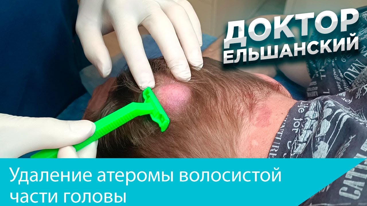 Удаление атеромы волосистой части головы. Removal of atheroma of the head