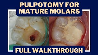 Pulpotomies for Irreversible Pulpitis? The Rise of Vital Pulp Therapy  PDP133