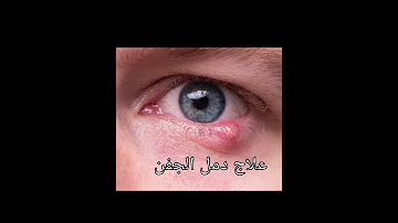 علاج دمل الجفن 