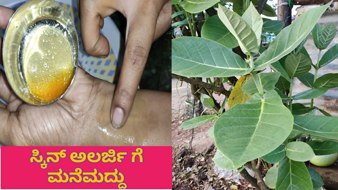 ಸ್ಕಿನ್ ಅಲರ್ಜಿಗೆ ಮನೆಮದ್ದುಕಜ್ಜಿಗೆ ಮನೆಮದ್ದು ಚರ್ಮ ರೋಗ skin allergy in