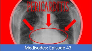 Pericarditis – Medisodes Episode 43