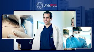 Hair Transplant Journey of Dr. Guncel Ozturk, founder of Hairneva - Part 1