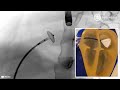 How it works transcatheter closure of atrial septal defect asd