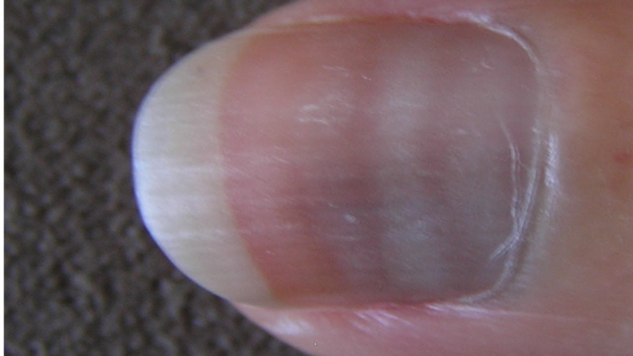 Are those white spots on your fingernails signs of calcium deficiency?