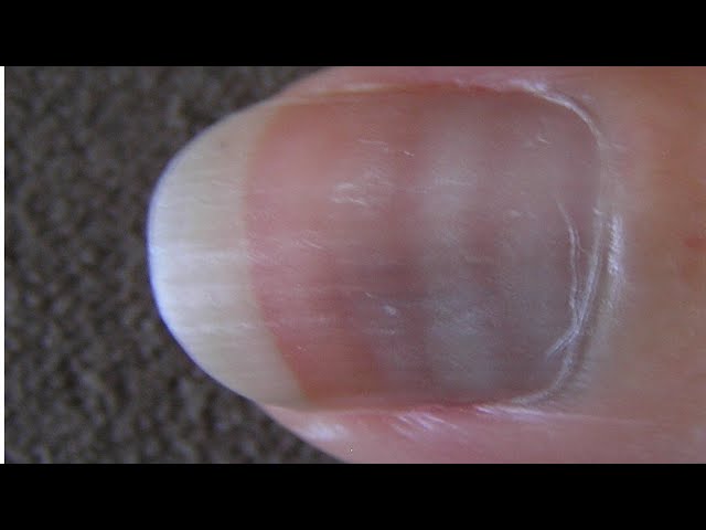 Fingernail beds appearance two months after carbon monoxide intoxication. |  Download Scientific Diagram