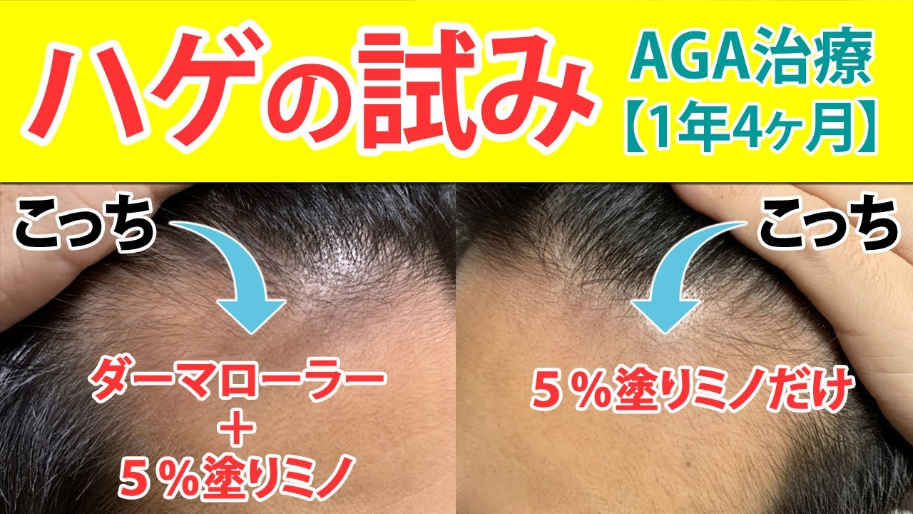 ハゲの試み 片方のm字だけダーマローラーを使用するとどうなるのか Aga治療 薄毛治療体験レポート1年4ヶ月目 薄毛に悩む30代40代男性向け Youtube