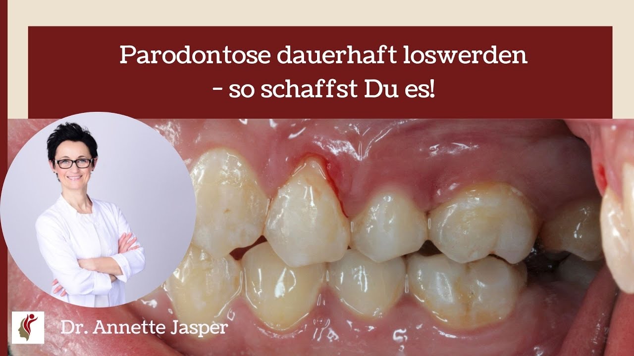 Parodontose dauerhaft loswerden - so schaffst Du es!