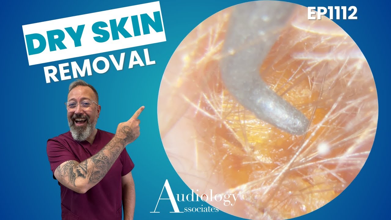 You Won't Believe How Much Dry Skin is Removed From This Ear - EP1112