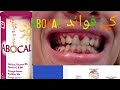 Abocal Tablet Benefits Viralvideo Abocal Tablet Benefits Viralvideo