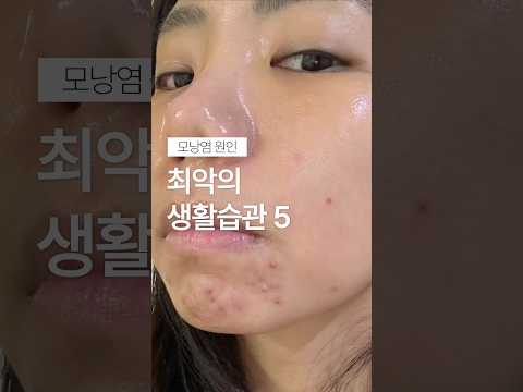 이렇게 하면 무조건 여드름 올라옴 !