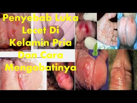 penyebab-luka-lecet-di-kelamin-pria-dan-cara-mengobatinya