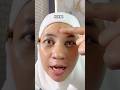 SOLUSI JERAWAT….