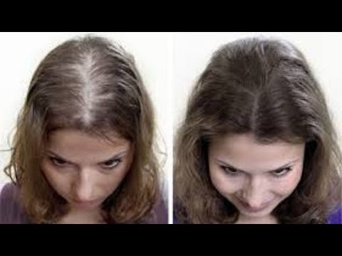 Βίντεο: Θα μεγαλώσουν ξανά τα μαλλιά μετά την κρανιοτομή;
