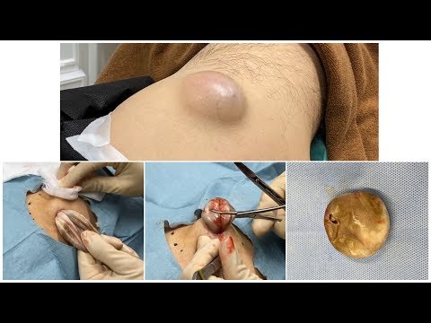 Epidermal cyst using skin biopsy in Osaka  Dr.Gen