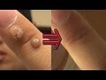 ２年間悩まされたイボを除去する方法｜How to remove wart