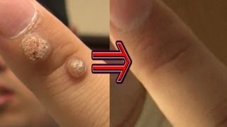 ２年間悩まされたイボを除去する方法｜How to remove wart