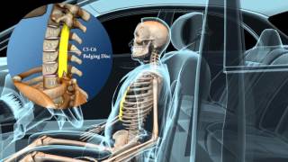 Occupant Kinematics