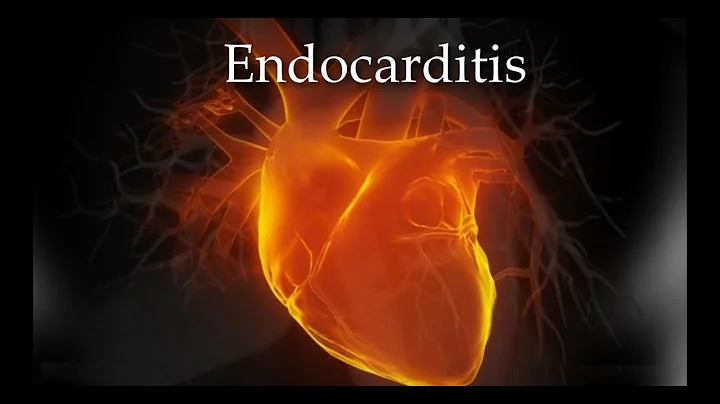 Infective Endocarditis - Animation + Mind mapping (risk factor, physical exam, diagnosis, treatment)