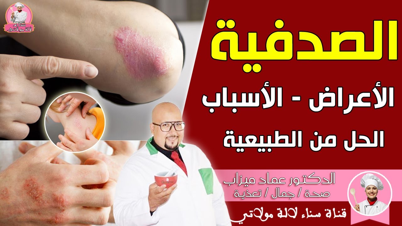 الصدفية : الأعراض , الأسباب , الحل من الطبيعية من عند الدكتور عماد ميزاب