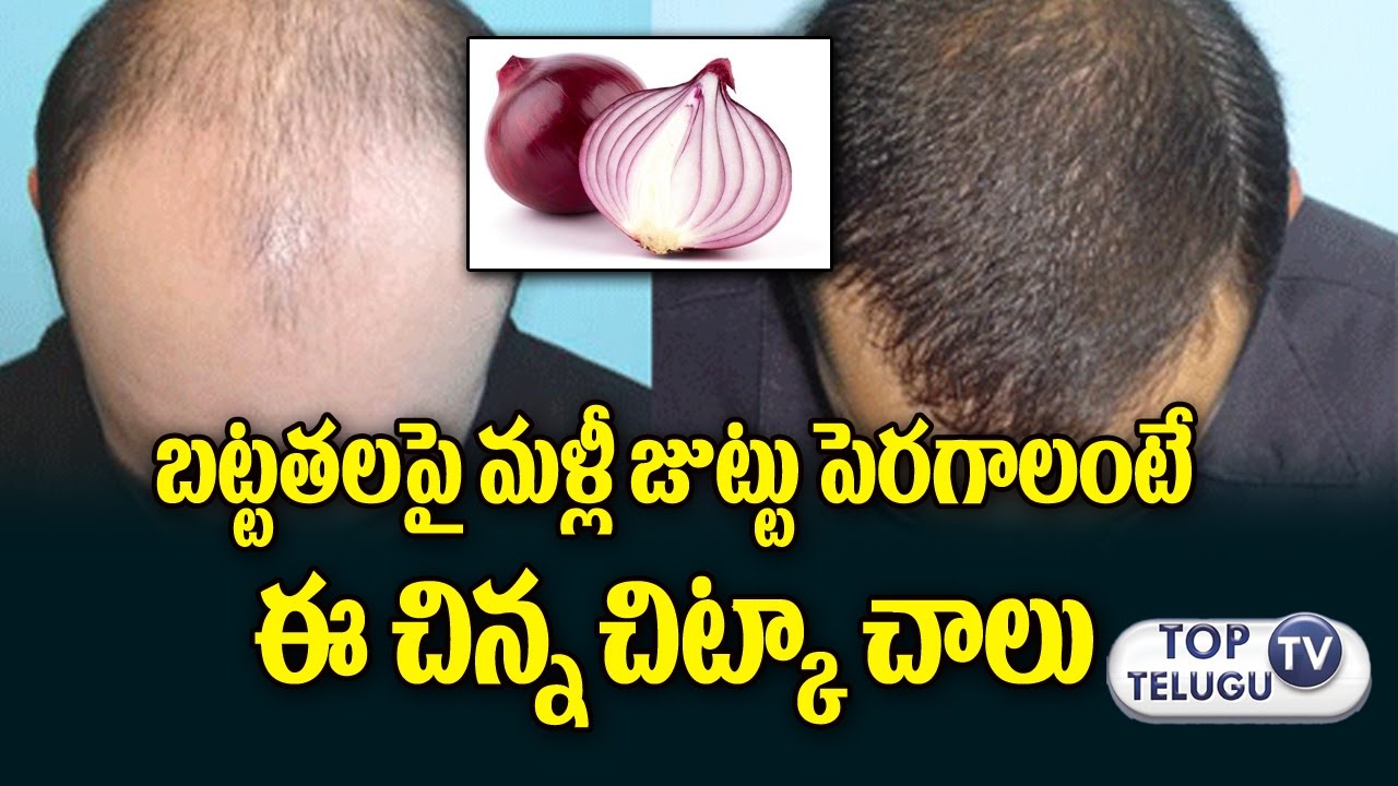 బట్టతలపై జుట్టు పెరగాలంటే | Natural Remedies for Bald Head | Telugu Health  Tips | Hair Loss Solution - YouTube