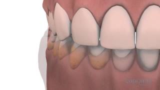 Gingivoplasty and gingivectomy - Lapointe dental centres