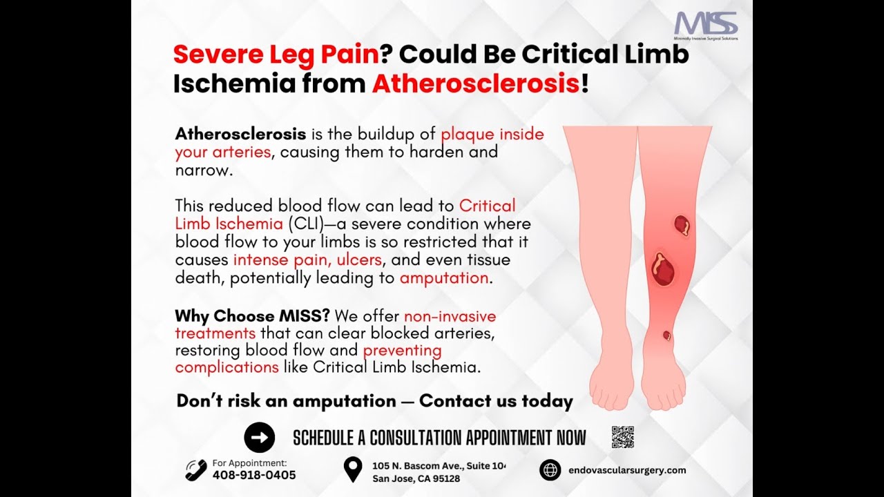 How Atherosclerosis Causes Critical Limb Ischemia - YouTube
