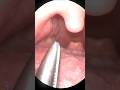 ENT विशेषज्ञ द्वारा फिश बोन रिमूवल | गले की दर्दनाक समस्या का समाधान 😲 #FishBone #Doctor #ENT