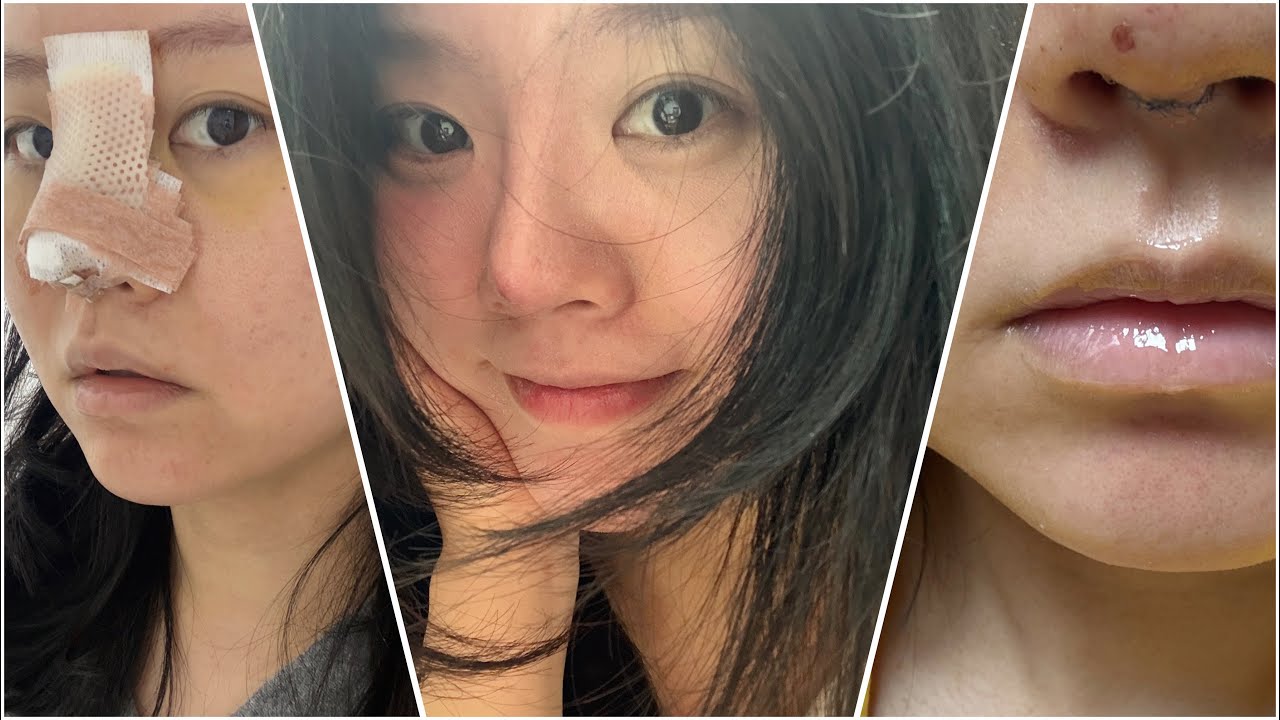 브이로그 : 일주일동안 못생김 최대치🥹 코보형물제거 후기 (통증 + 수술후기 + 회복기간) 나 내코 좋았는데 고마웠어..  내코 안녕😭