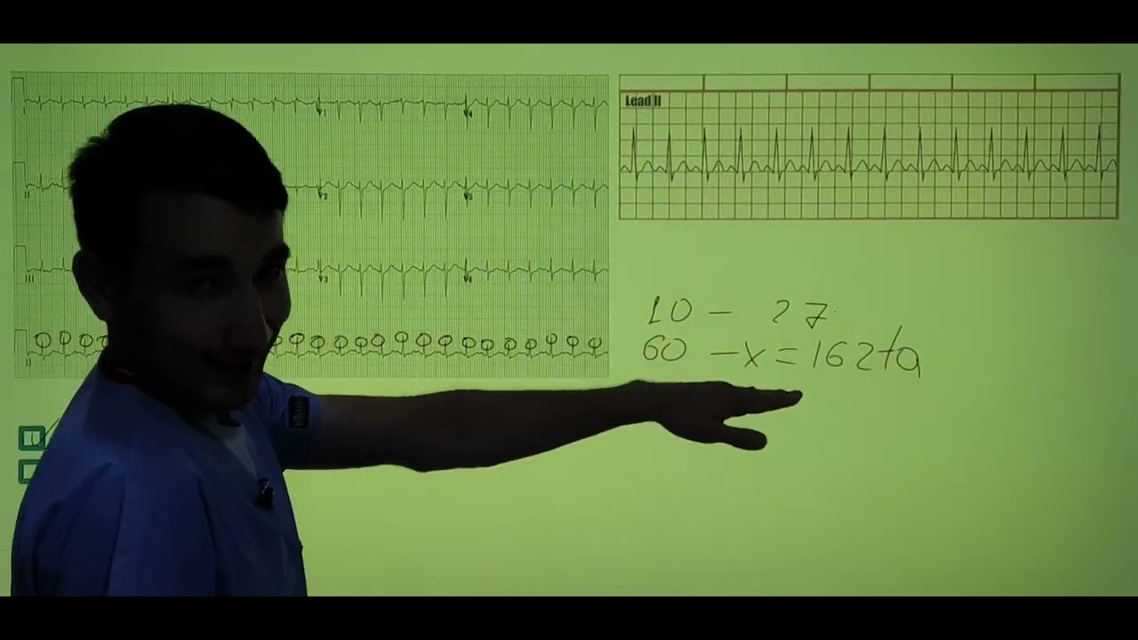 Bradikardiya va Taxikardiyani EKG da aniqlash.