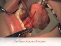 Frenectomy for Management of Ankyloglossia Tongue Tie