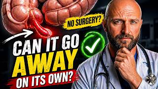 Appendicitis Without Surgery: When Antibiotics Are Actually an Option