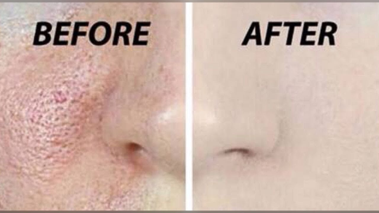How to Get Rid Of Pimple/Acne Pits & Open Pores Shrink