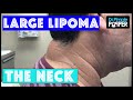 Large Lipoma on the Posterior Neck Large Lipoma on the Posterior Neck