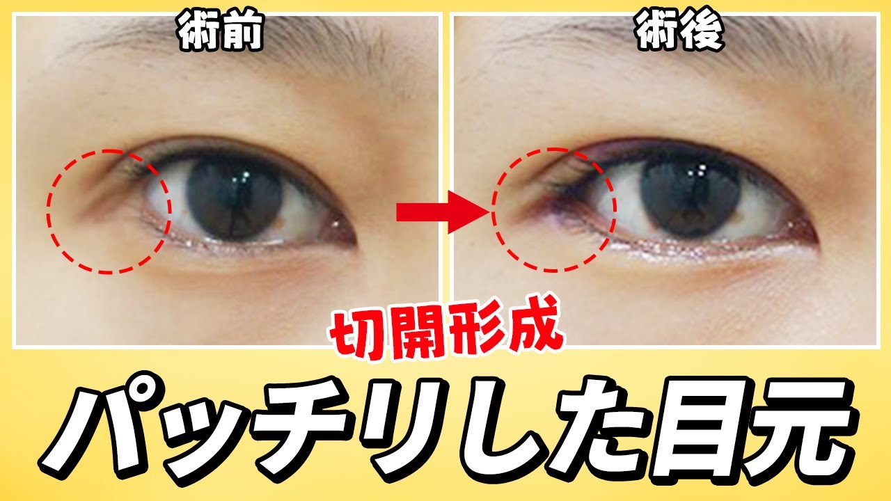 #目の手術 #切開手術 #目頭切開 #目の上切開 #目尻切開 #タレ目形成