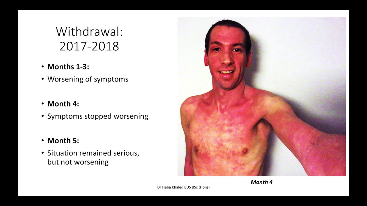 Topical steroid withdrawal